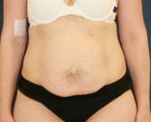 Feel Beautiful - Tummy Tuck with Hernia Repair - Before Photo